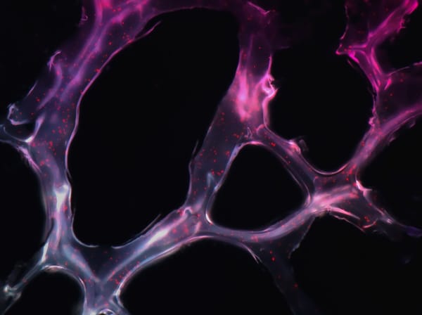 55 Million Affected: Scientists Just Found a New Way Alzheimer’s Kills Brain Cells – And How to Stop It